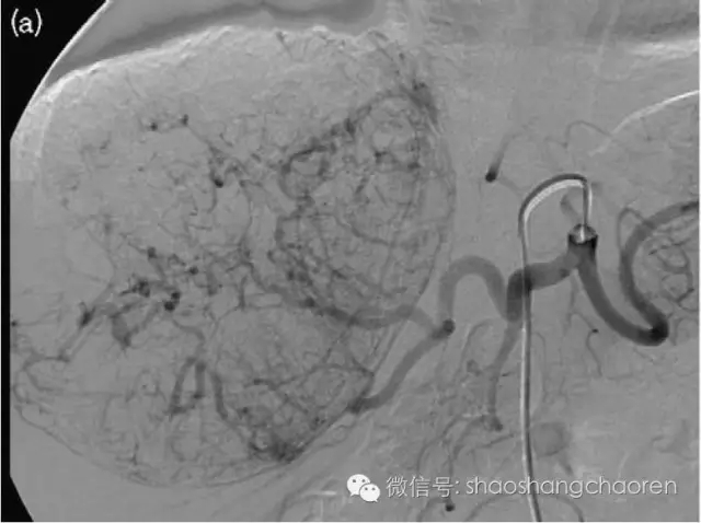 “十几块钱的小苏打饿死癌细胞”？－－看媒体如何把科学改造成谣言？